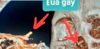 Hombre que sufría dolores de cabeza se entera de que tenía palillos clavados en el cerebro