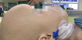 Descubren feto creciendo en el cráneo de una bebé de 1 año; era su gemela